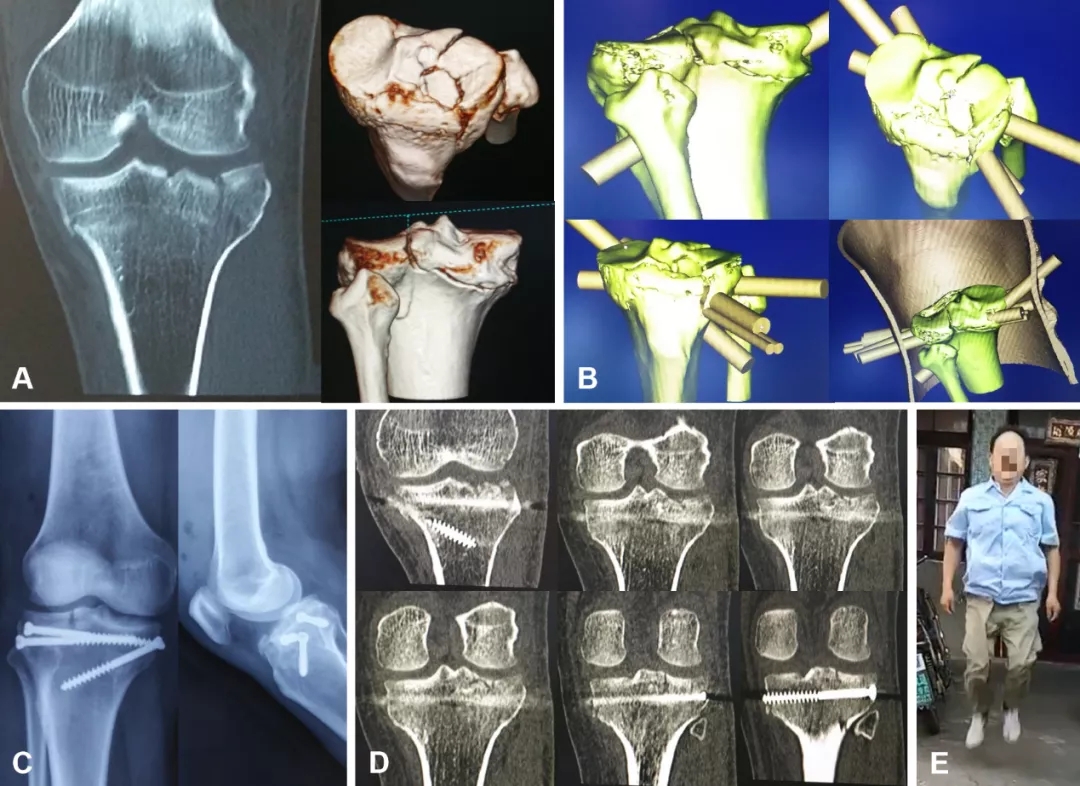 常见骨折类型X片–探讨分析1 - 知乎