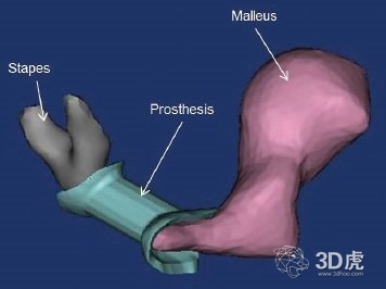 马里兰州研究人员3D打印中耳假肢